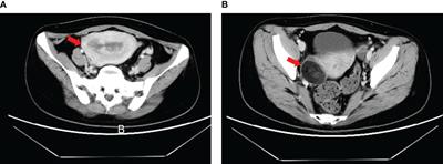 Case Report: Extragonadal Yolk Sac Tumors Originating From the Endometrium and the Broad Ligament: A Case Series and Literature Review